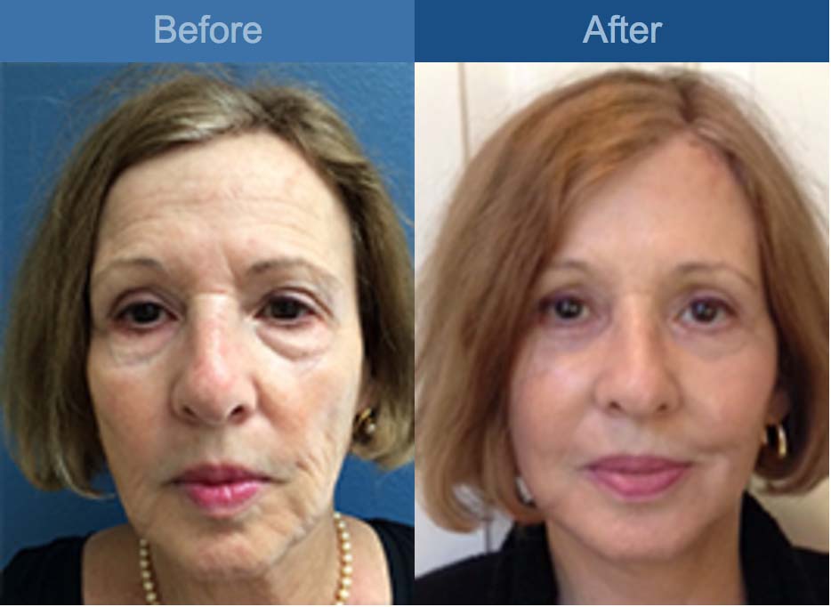 facelift