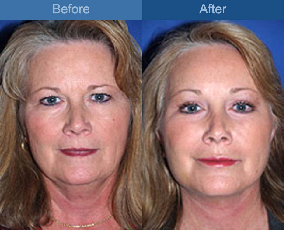 face lift procedure