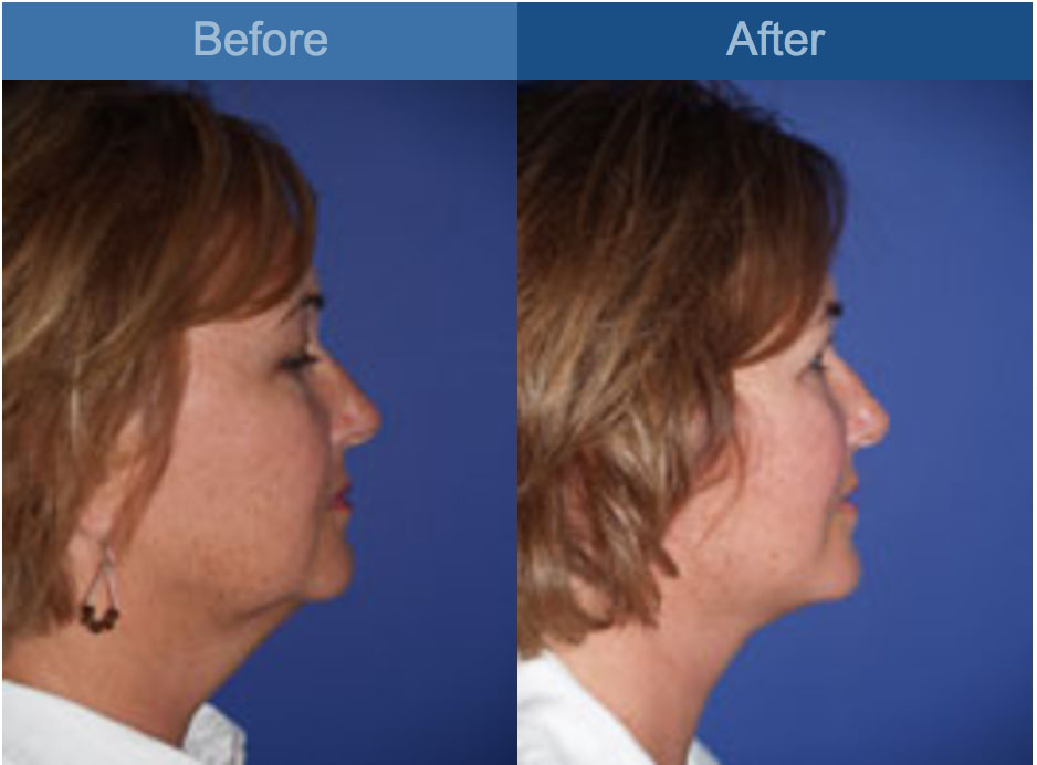 face lift procedure before and after