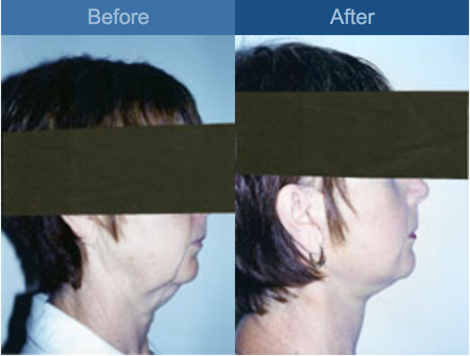face lift before and after