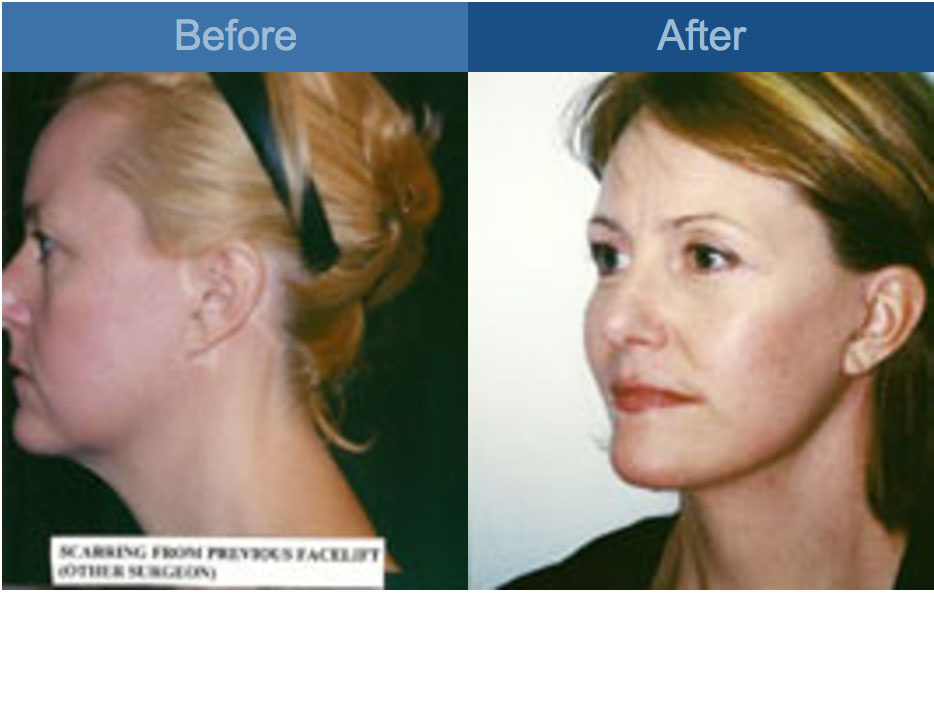 facelift atlanta