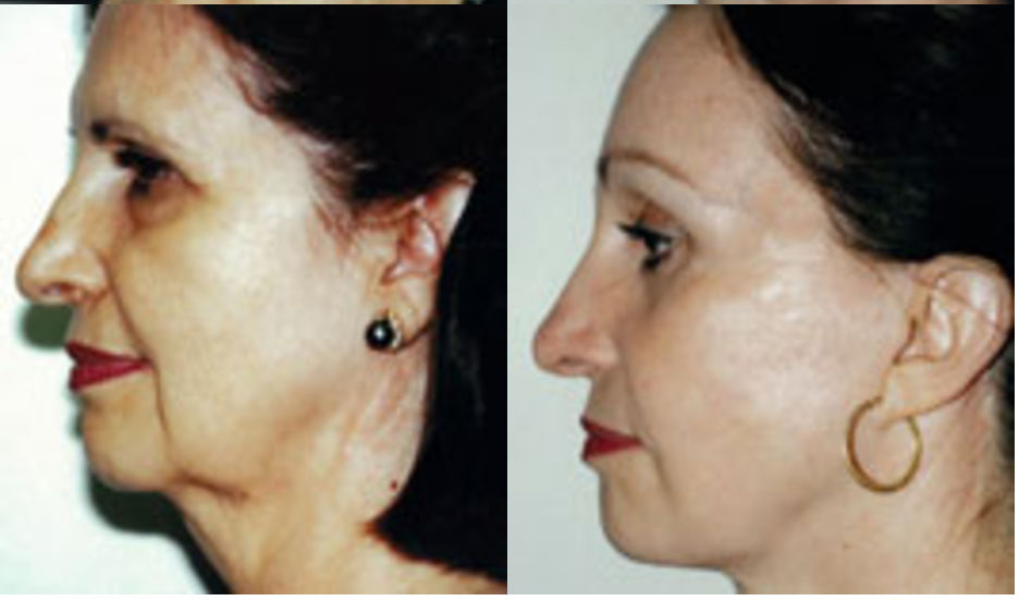 facelift before and after