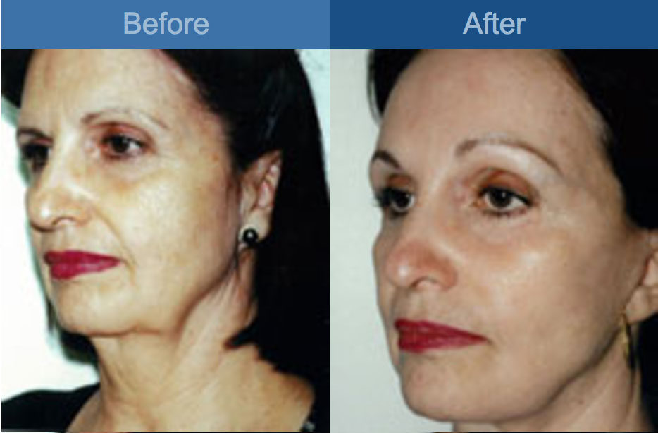 facelift procedure