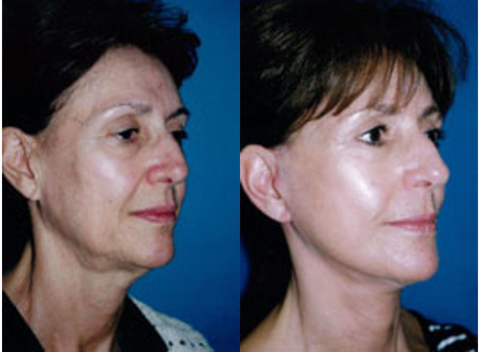 facelift surgery