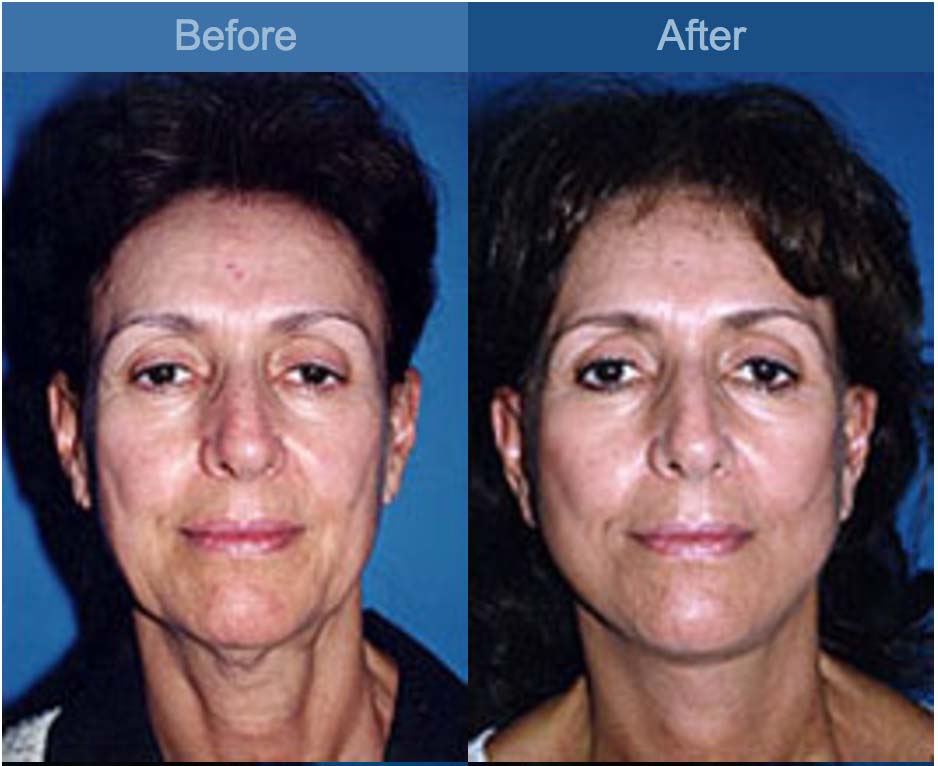 facelift before and after
