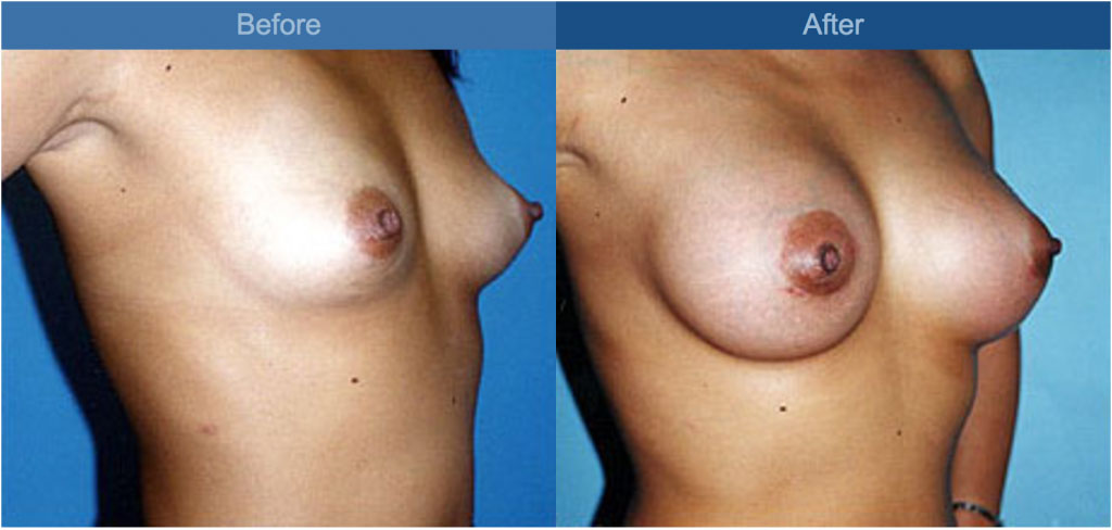 breast enhancement side