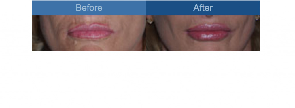 lip augmentation