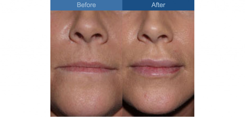 lip augmentation before and after