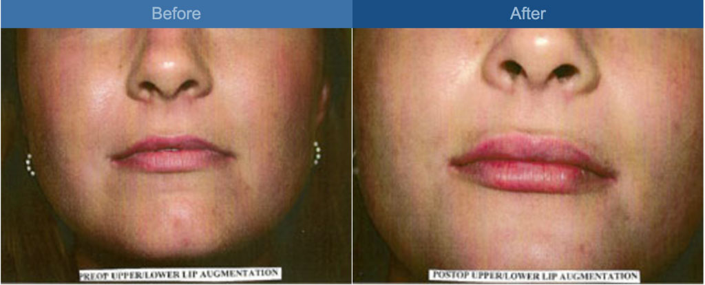 lip augmentation procedure