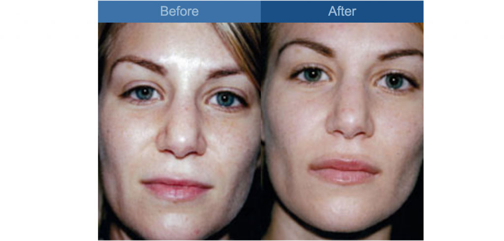 lip augmentation surgery