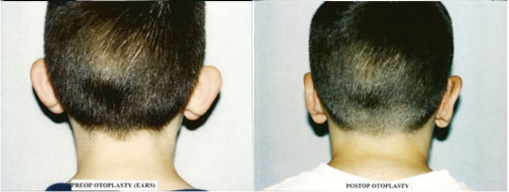 otoplasty surgery