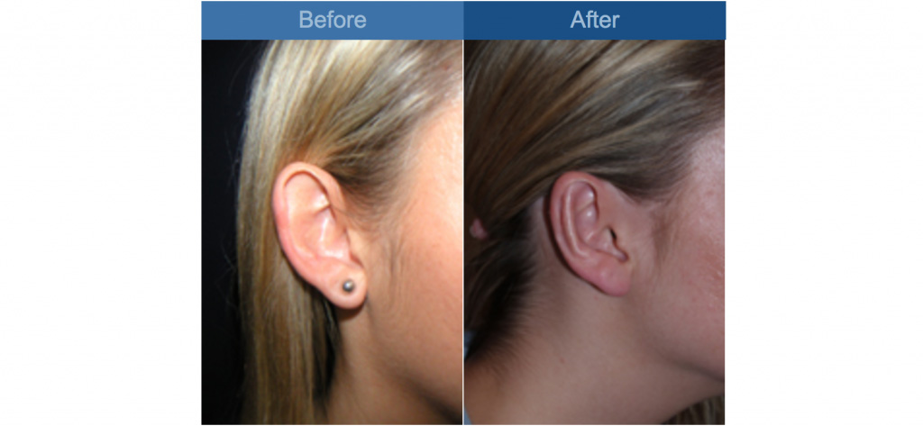 otoplasty